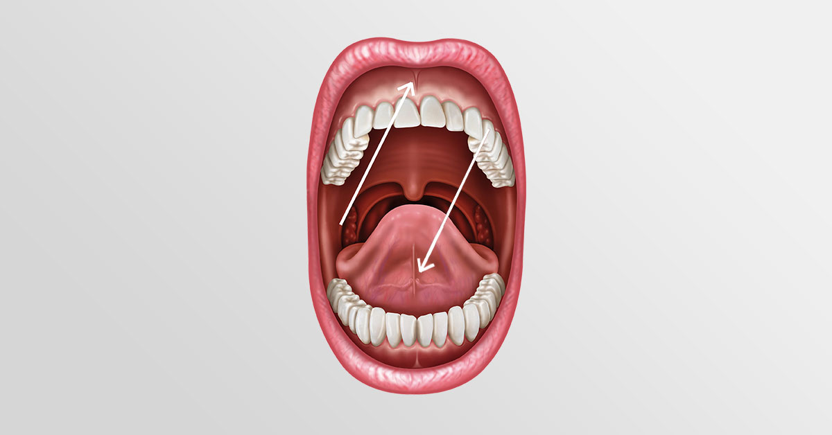 Excision - Removal of Upper Jaw and Tongue