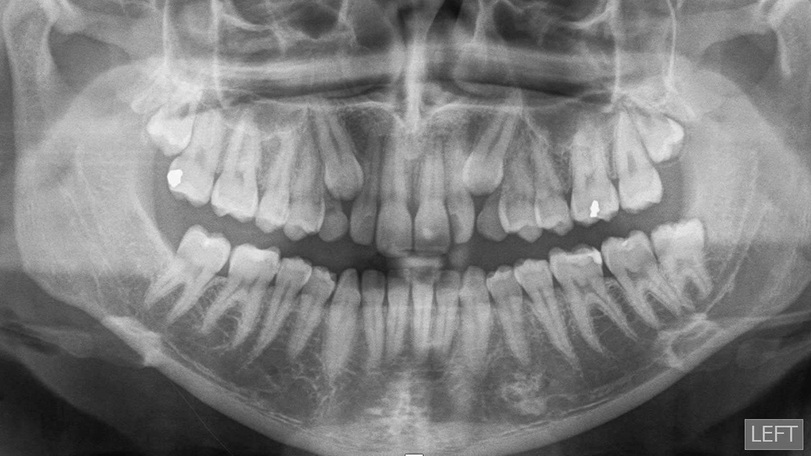 Enclosed teeth